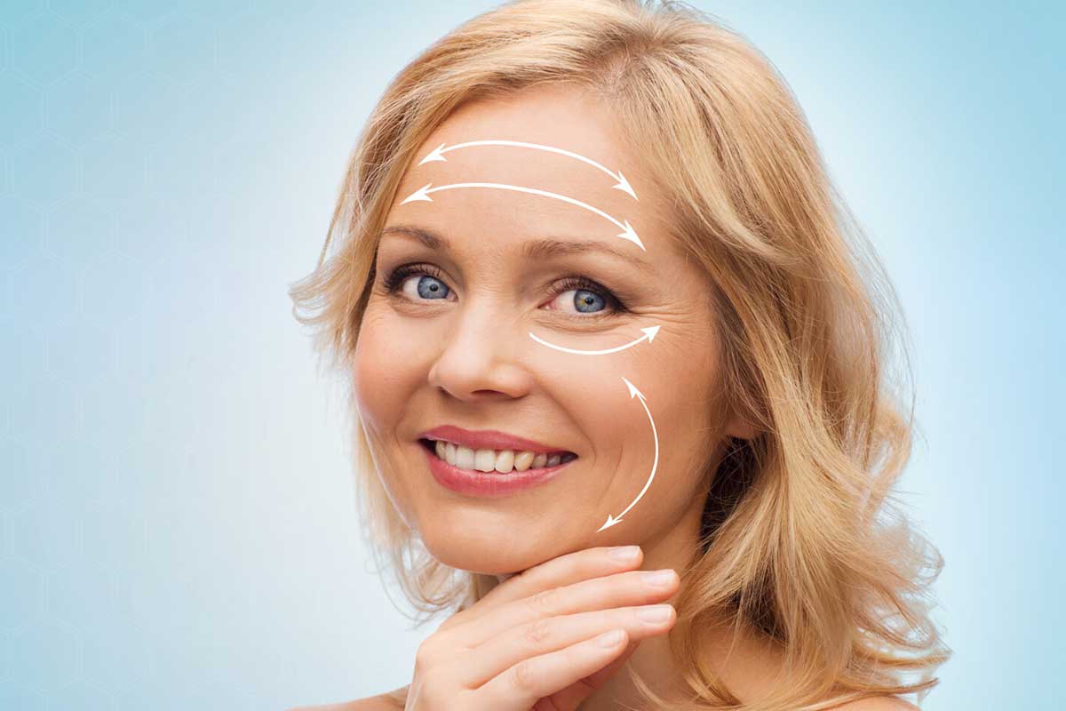 50-year-old model displaying the optimal skin movement direction of a facelift surgery.